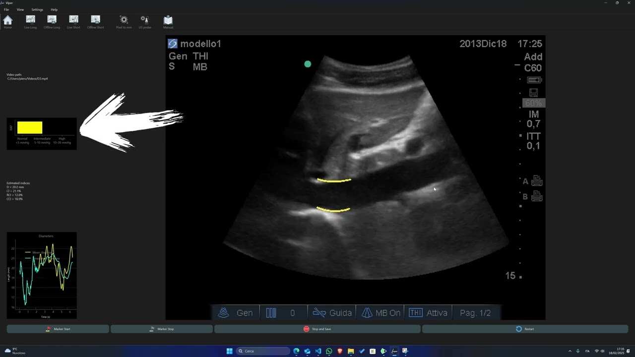 Introducing a New Indicator for Right Atrial Pressure (RAP) integrated with VIPER