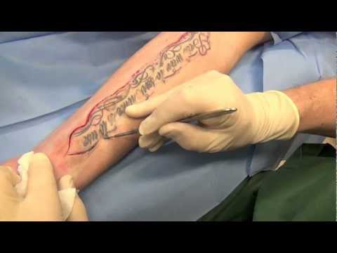 Video: Tatuering ärr: Kan Jag Behandla Eller Ta Bort Oönskade Tatuer ärr?