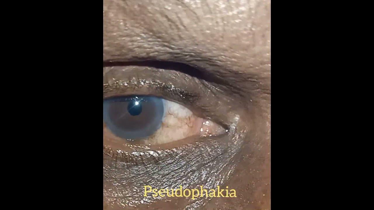 Mature cataract pseudophakia senile mature cataract pseudophakia