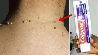 तिल और मस्से को जड़ से ख़त्म करने का सबसे अच्छा उपाय - Remove Skin Tag Naturally