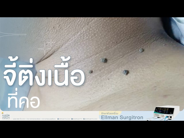 จี้ติ่งเนื้อที่คอ EP.369 บอกลาคอหนังไก่! จี้ติ่งเนื้อนับสิบจุด @หมอปุ๊ NeramitClinic