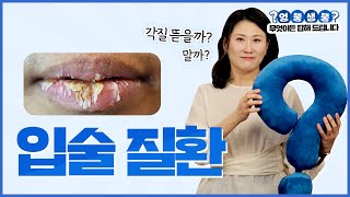구순염, 맥관부종, 헤르페스 입술질환  각질제거할까? 화장품은? 보습제는?