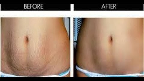 FASTEST METHOD TO REMOVE STRETCH MARKS WITH ALOE AND