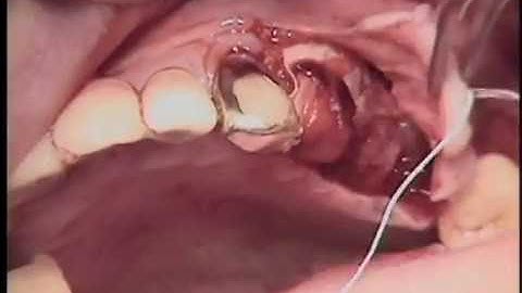 Horizontal Augmentation using Ridge Augmentation and Ti-mesh