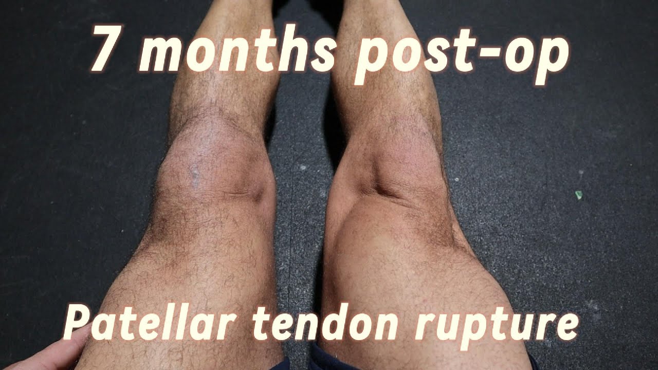 7 months post op Patellar tendon rupture