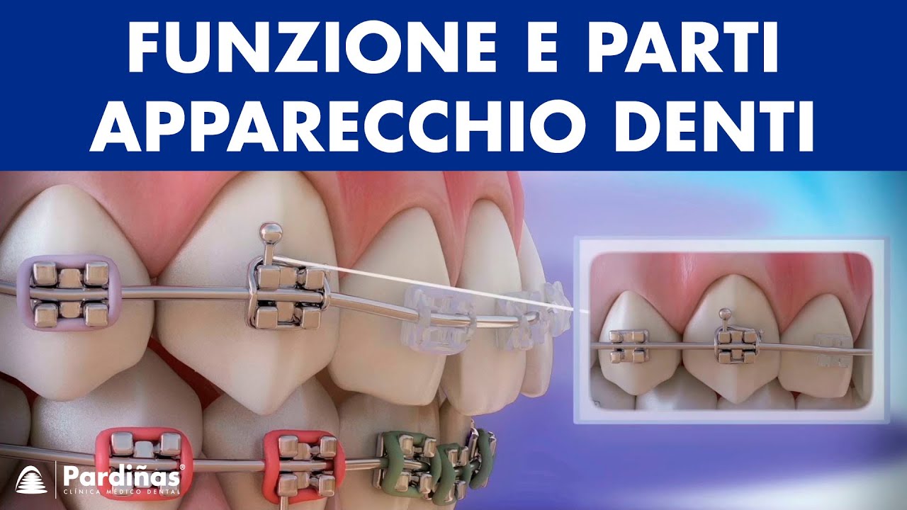 L'apparecchio fisso ortodontico: a cosa serve?