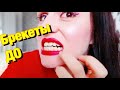 Я РАЗОРЯЮ СВОЮ СЕМЬЮ🤦🏻‍♀️ ОРТОДОНТИЧЕСКИЙ ДНЕВНИК #1