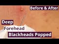 Deep Forehead Blackheads Popped — Shocking Before & After #16