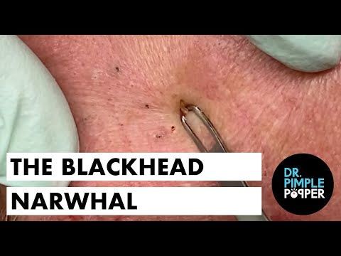 The Blackhead Narwhal