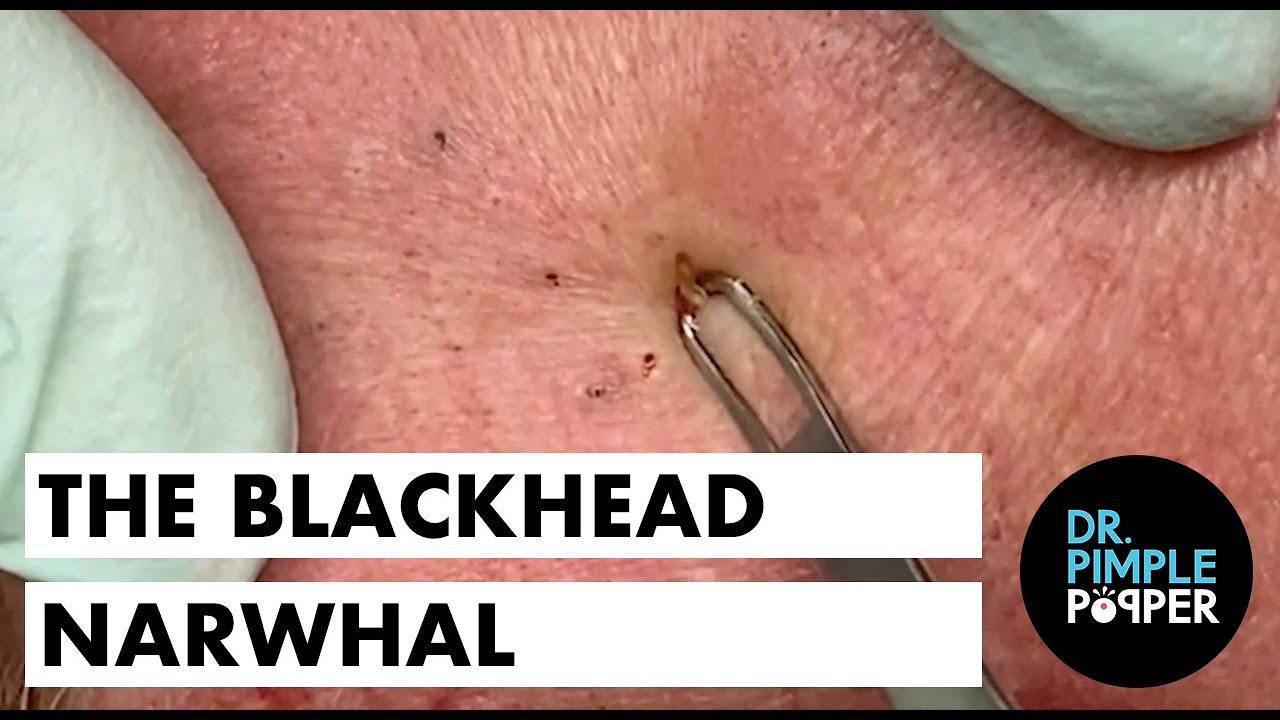 The Blackhead Narwhal Youtube
