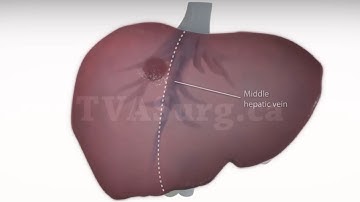 Standard right hepatectomy