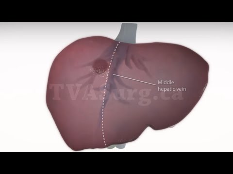 Video: Je, hepatectomy inaumiza?