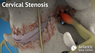 Cervical stenosis
