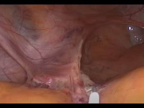 Video: Ovariektomiyaya Qarşı Yumurtalıqistertomiya