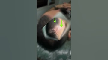 Hói chữ M và cách chúng tôi giúp anh ấy cải thiện bằng xăm tóc #reviewxămtóc