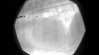 Patent Ductus Arteriosus Angiogram Following Vascular Plug
