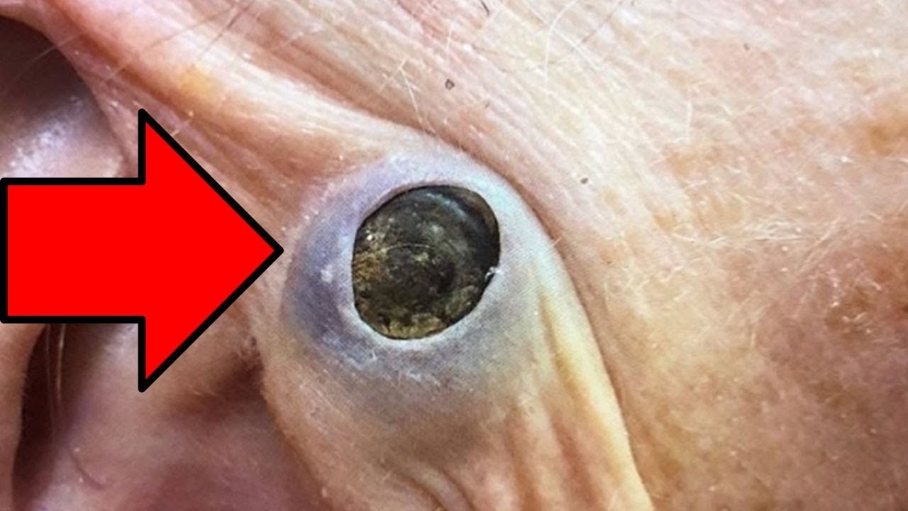 The Biggest Dilated Pore Of Winer