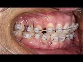 Цифровая Ортодонтия, брекеты, элайнеры, изменения прикуса #впольше  в #варшава