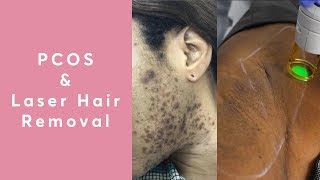 Does Laser Hair Removal Work For PCOS?