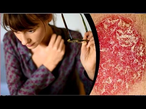 Video: Псориаз болгондо макияж жасоонун 3 жолу