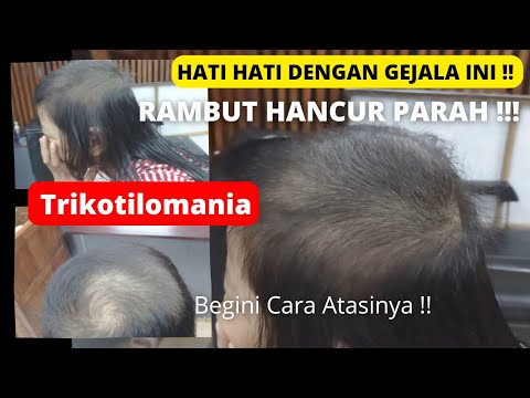 RAMBUT DIBOTAKIN - PAHAMI APA INI !!! - APA ITU Trikotilomania - MENYEMBUHKAN TRIKOTILOMANIA