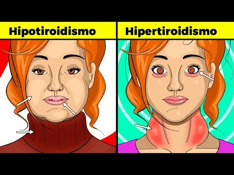 Síntomas de tiroides en mujeres (hipotiroidismo e hipertiroidismo): signos, causas y tratamiento