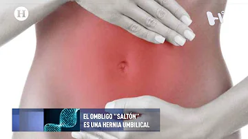 ¿De qué color es una hernia umbilical?