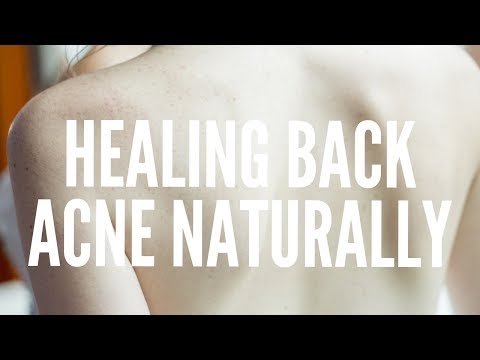 Natural Tips for Back Acne