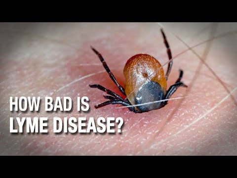 Video: Cara Mengobati Post Lyme Disease Syndrome: 14 Langkah (dengan Gambar)