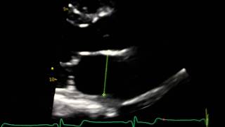 LA 2-D measurement in PLAX