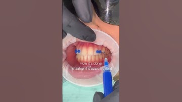 Invisalign fit appointment, including placing attachments 🙌 #Invisalign #orthodontist