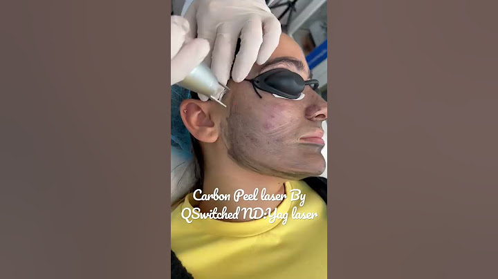 Laser Carbon peel for skin rejuvenation and glowing skin #olimpiacarmen #hollywoodpeel