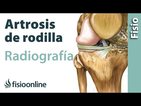 Vídeo: Osteoartritis De La Radiografía De Rodilla