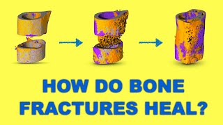 Bone tissue engineering | Bone healing