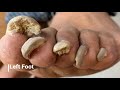 Toenail fungus dc foot doctor