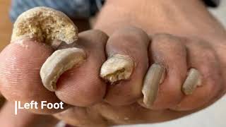 Toenail Fungus! DC Foot Doctor
