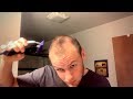 RECEDING HAIRLINE SINCE 17 - Shaving My Head Embracing Going Bald (LIVE) 2