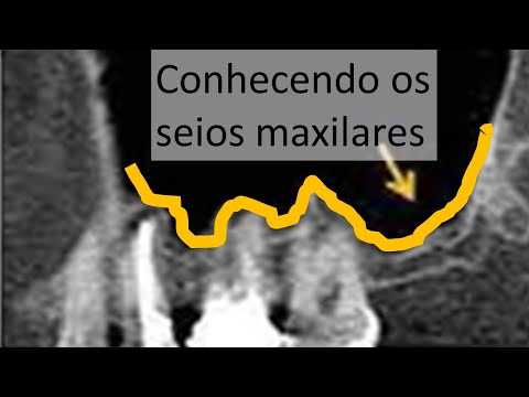 Vídeo: Seios maxilares