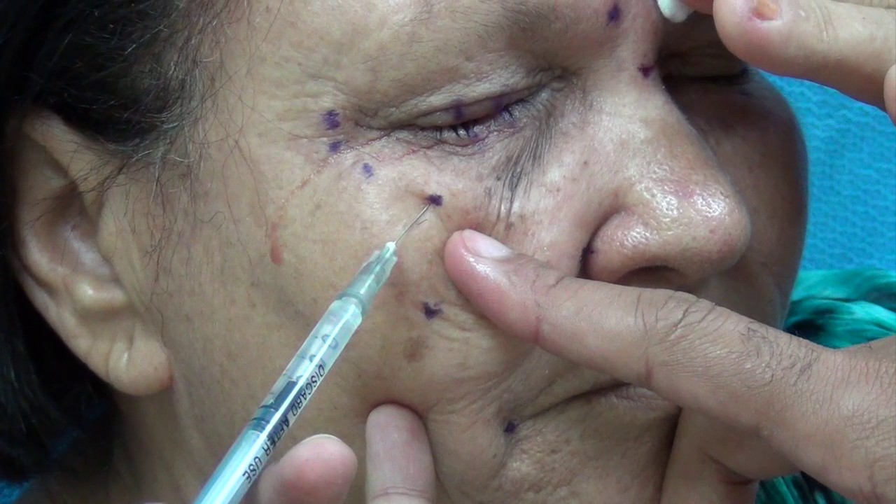 Inyección De Toxina Botulínica En Fisuras Anales Espasmo Hemifacial. Aplicación de Toxina Botulínica - YouTube