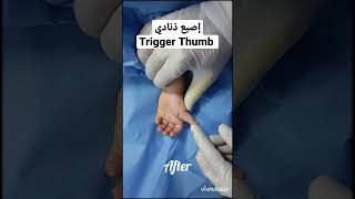 الأصبع الزنادي عند الأطفال قبل وبعد التصليح، د. أحمد فوزي إستشاري جراحات عظام الأطفال والتشوهات