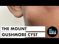 Mount Gushmore the Cheek Cyst
