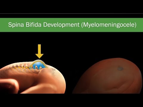 Fetal Spina Bifida: Comprehensive Guide on Diagnosis, Treatment & Surgery