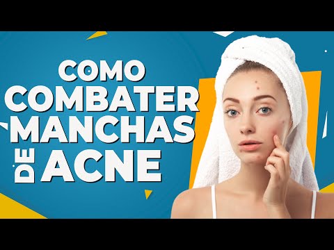 Como Combater Manchas de Acne - Dr Lucas Fustinoni