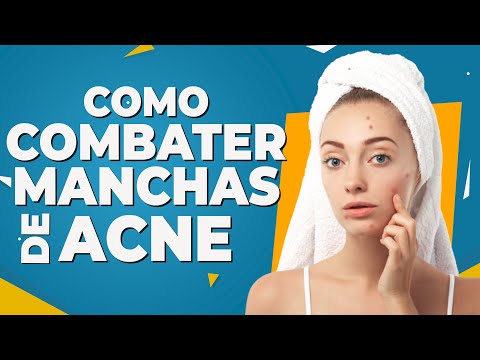 Vídeo: Como Remover Manchas Escuras Causadas Pela Acne: Tratamentos E Remédios