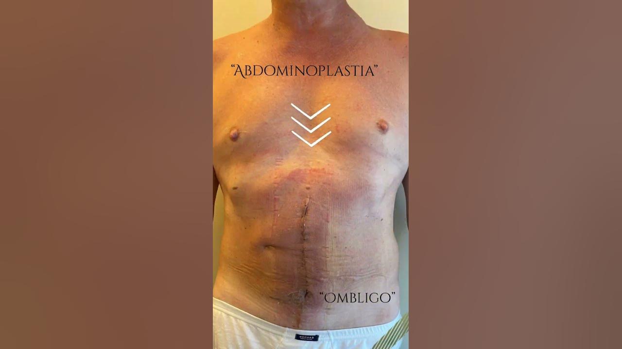 Recuperación de la abdominoplastia paso a paso - Cirugia Martinez