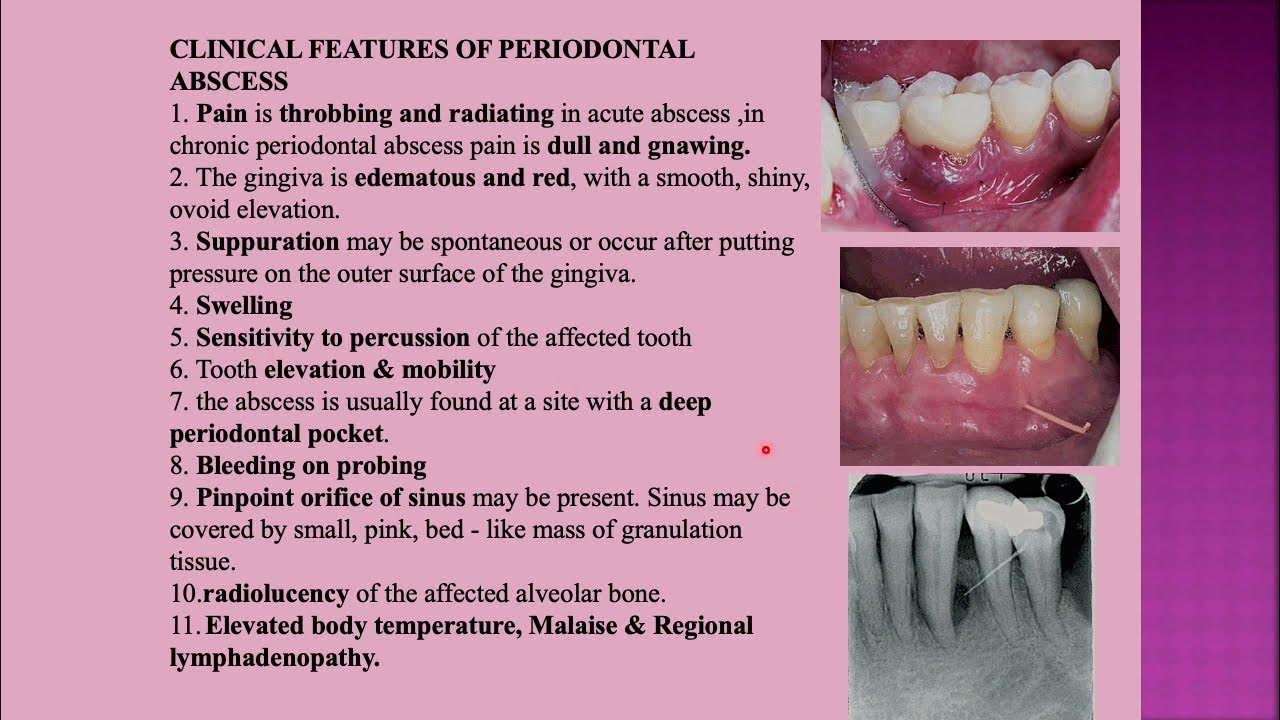 Periodontal Classification Part 2 YouTube