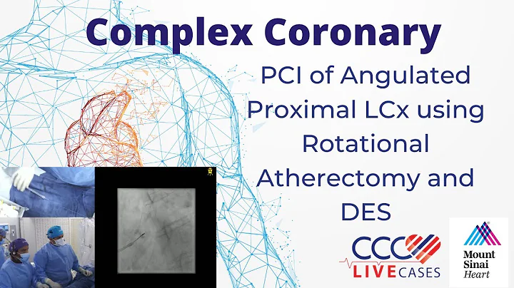 PCI of Angulated Proximal LCx using Rotational Atherectomy and DES