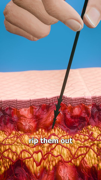 How To Remove Porcupine Quills 😷