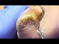 Deeply Ingrown, Blackened Toenails, Gently Trimmed【Xue Yidao】