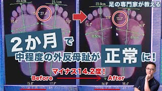 【足の専門家が教える】外反母趾徹底解説。どう発生しどんな問題があり、どうやって治るのか。